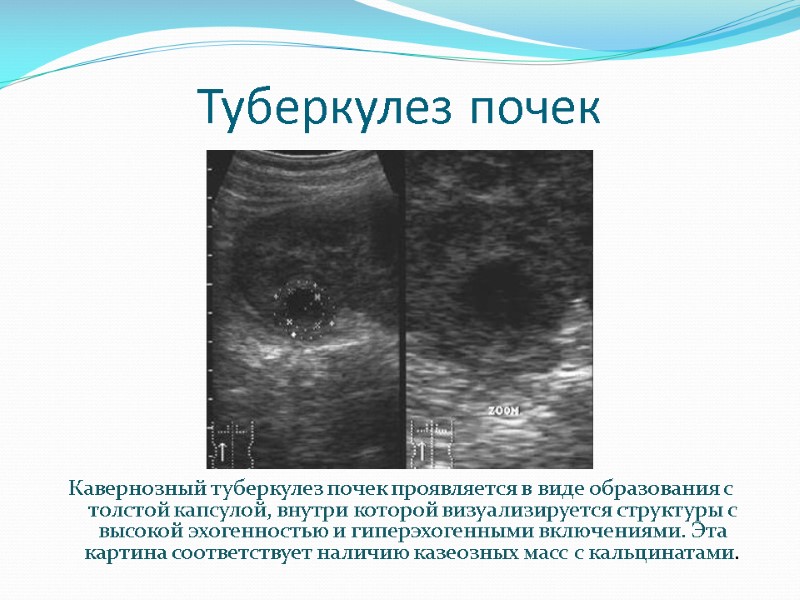 Туберкулез почек Кавернозный туберкулез почек проявляется в виде образования с толстой капсулой, внутри которой